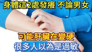 身體這2處發癢，不論男女，可能肝臟在變硬？很多人以為是過敏 [upl. by Melony]