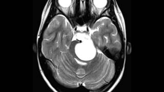 Pilocytc Astrocytoma [upl. by Atinuhs]