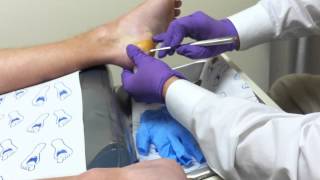 Plantar Wart Surgical Removal [upl. by Wilinski]