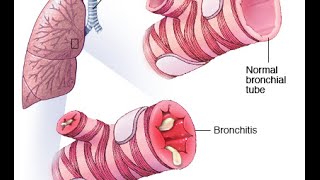 Bronchitis PEV [upl. by Ytsirt]