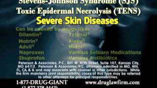 Dilantin Lawsuit SJS Side Effects with Dilantin [upl. by Wiburg]