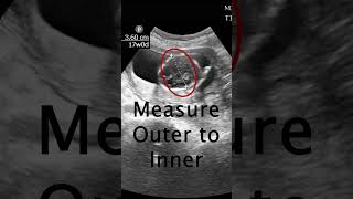 How to measure a Biparietal Diameter POCUS Ultrasound emergencymedicine obgyn [upl. by Shena172]