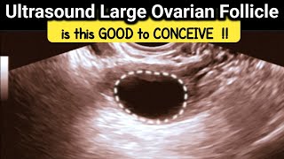 what is Large Ovarian Follicle  is it GOOD to CONCEIVE  TVS Ultrasound [upl. by Liew]