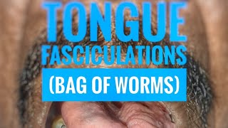 Tongue fasciculations quotBag of wormsquot  mbbs medicine neurology [upl. by Eiramannod917]