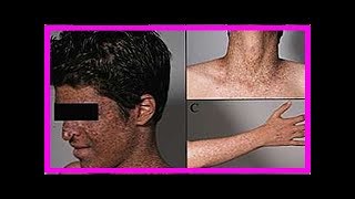 Xeroderma pigmentosum was es ist Symptome und wie die Behandlung ist [upl. by Suravart]