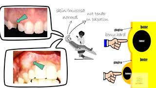 Adenomatoid odontogenic tumor [upl. by Iaka40]