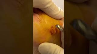 Watch this plantar wart removal surgery  a satisfying procedure for foot enthusiasts [upl. by Eedrahc]