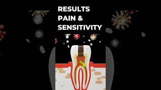 how bad bacterias affect your healthy toothmanagement of decayed tooth cavity  dental [upl. by Towne]