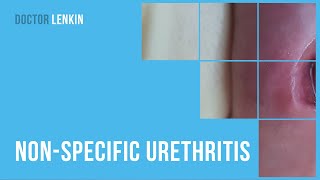 😟 Nonspecific urethritis [upl. by Dnomder]