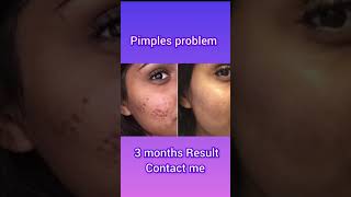 Pimple clear combo available youtubeshorts [upl. by Nafets]