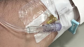 CHEMO vlog session 2 🧠 TUMOUR [upl. by Notrom474]