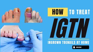 Ingrown Toe nails Causes Treatment and Prevention [upl. by Gerge]