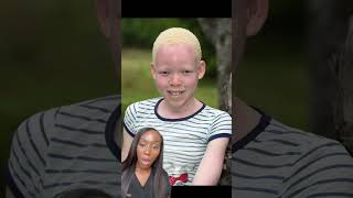 Albinism Understanding the Genetic Condition and Its Impact [upl. by Lime]