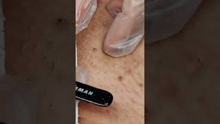 10 Minutes of Ingrown hair removal BIKINI AREA [upl. by Hazard]