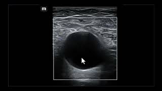 Achados ultrassonográficos e diagnósticos diferenciais da linfocele axilar [upl. by Hanschen]