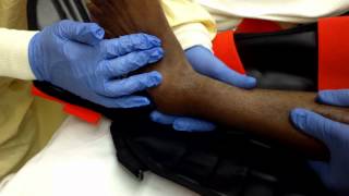 Ankle Dislocation Reduction [upl. by Nylodnarb]