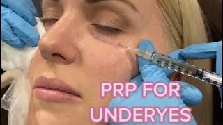 Undereye PRP Injections [upl. by Tnomed]