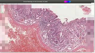 Histopathology  Dieulafoy Lesion  Stomach [upl. by Narruc]