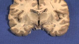 Hypothalamus Neuroanatomy Video Lab  Brain Dissections [upl. by Tildy]