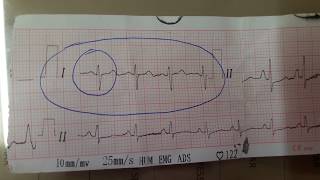 Cor Pulmonale ECG [upl. by Eitteb]