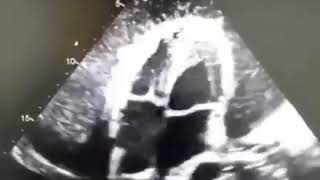 Constrictive Pericarditis with tamponade  Echo Clip  The Echo Channel [upl. by Gnoht804]