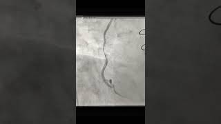 Angioplasty of SVG to PDA Graft with Embolic protection device in post CABG patient after 5 year [upl. by Fifi974]