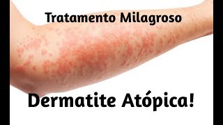 Tratamento para Dermatite Atópica [upl. by Torrin23]