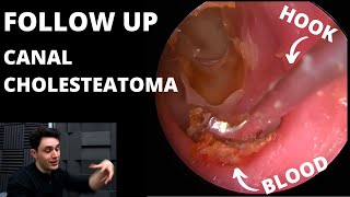 FOLLOW UP Canal Cholesteatoma Patient Is Back [upl. by Etz]