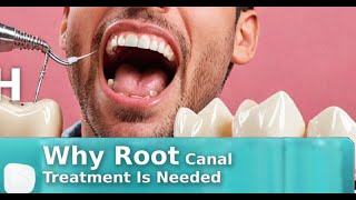 Dental Abcess Why Root Canal Treatment Is Needed [upl. by Stiruc]