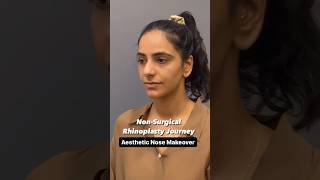 Non Surgical Rhinoplasty Journey  Before amp After Nose Transformation  Cara Clinic Mumbai [upl. by Esinej]