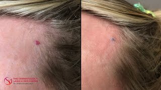 Cherry Angioma Removal with Laser  Dr Shalini Gupta [upl. by Romie647]