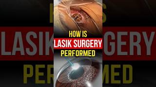 How Is Lasik Surgery Performed Live Lasik Surgery Procedure [upl. by Romelda145]