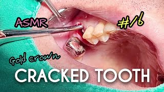 ASMR Broken Tooth Extraction [upl. by Natiha]