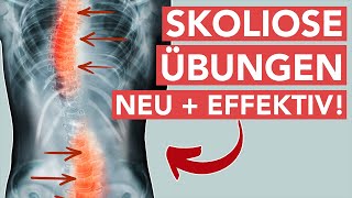 Skoliose übungen  Neue effektive Behandlungsmethode [upl. by Yttig342]