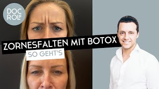 ZORNESFALTE mit BOTOX behandeln – darauf muss man achten Dr Rolf Bartsch [upl. by Anerual]