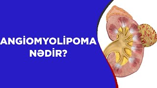 ANGİOMYOLİPOMA NƏDİR❓ [upl. by Aoket]