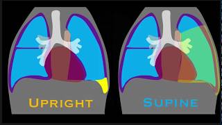 Pleural Effusion Explained by Prometheus Lionhart MD [upl. by Weisbart]