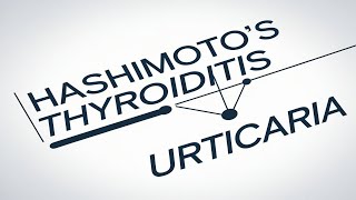 Understanding the Link Between Chronic Spontaneous Urticaria and Thyroid Health [upl. by Kcam]