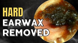 SOLID Hard Earwax Removed After Weeks [upl. by Schreck690]