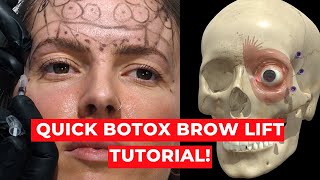 3D Botox BROW LIFT INJECTION TUTORIAL [upl. by Kotto]