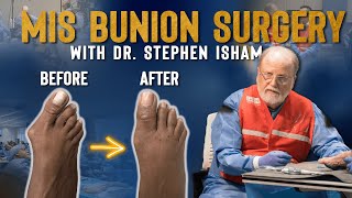 Minimally Invasive Bunion Surgery  Dr TJ Ahn [upl. by Margarette]