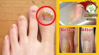 REMOVE THE FUNGUS FROM TOENAILS FOR GOOD WITH JUST 2 INGREDIENTS [upl. by Aidua702]