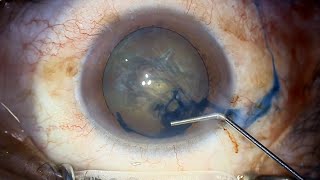 Resident case capsulorhexis woes [upl. by Groscr]