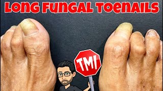 DEBRIDEMENT OF LONG FUNGAL TOENAILS [upl. by Assiluy]