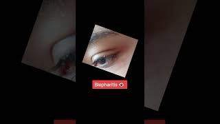 Blepharitis Eye Infection eye eyecarecentre eyedisorder eyecareservices lahorepakistan [upl. by Egwan853]