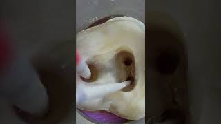 Root Canal Treatment Of Molar Tooth In 4K  Amazing Restoration shorts [upl. by Jaime975]