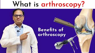 Benefits of Arthroscopic surgery [upl. by Reifel]