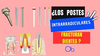 ¿Los postes intrarradiculares fracturan los dientes 🔩 🦷 [upl. by Griffy]