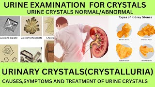 UEINE SEDIMENT EXAMINATION FOR URINARY CRYSTALSNORMAL AND ABNORMAL URINE CRYSTALSCAUSES TREATMENT [upl. by Bazil997]