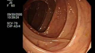 Colonoscopy Demonstrating a Moving Worm  NEJM [upl. by Carolin]